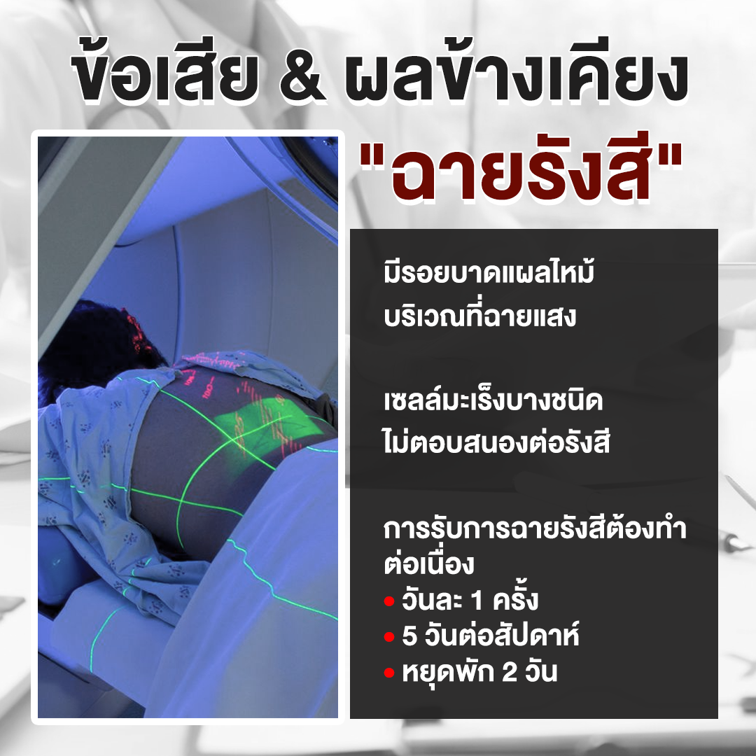 ผลข้างเคียงฉายรังสี