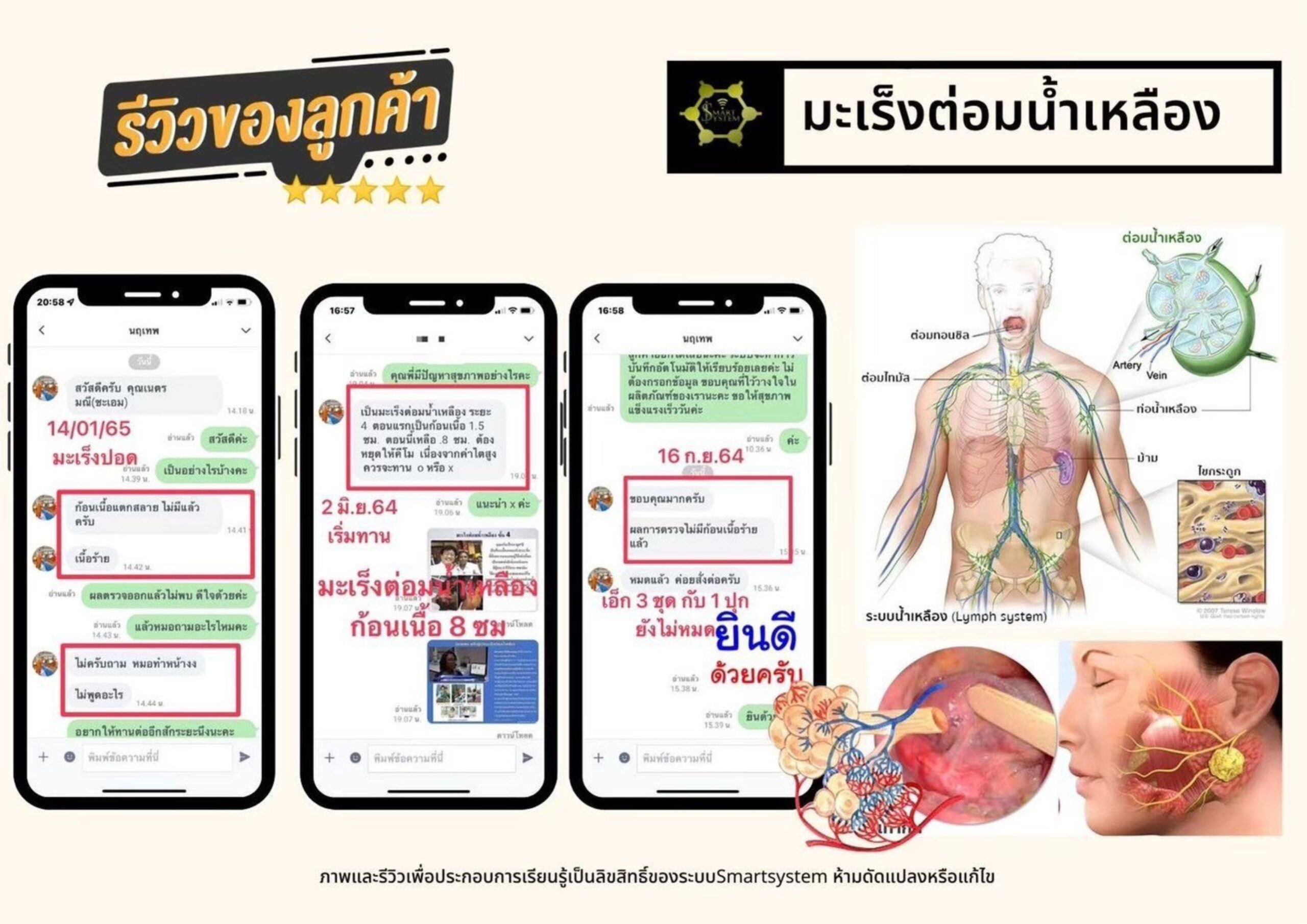 มะเร็งต่อมน้ำเหลือง