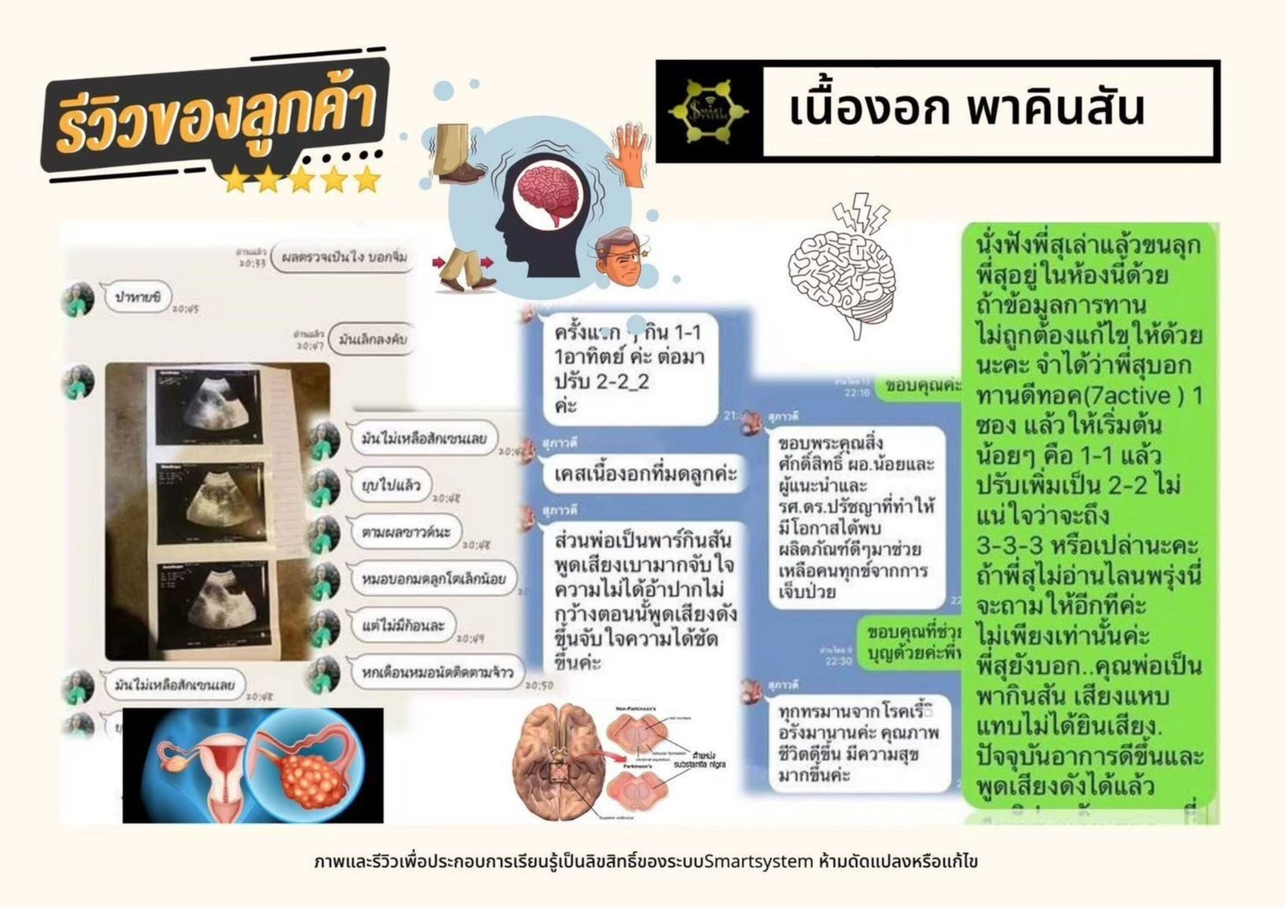 รีวิวเนื้องอก