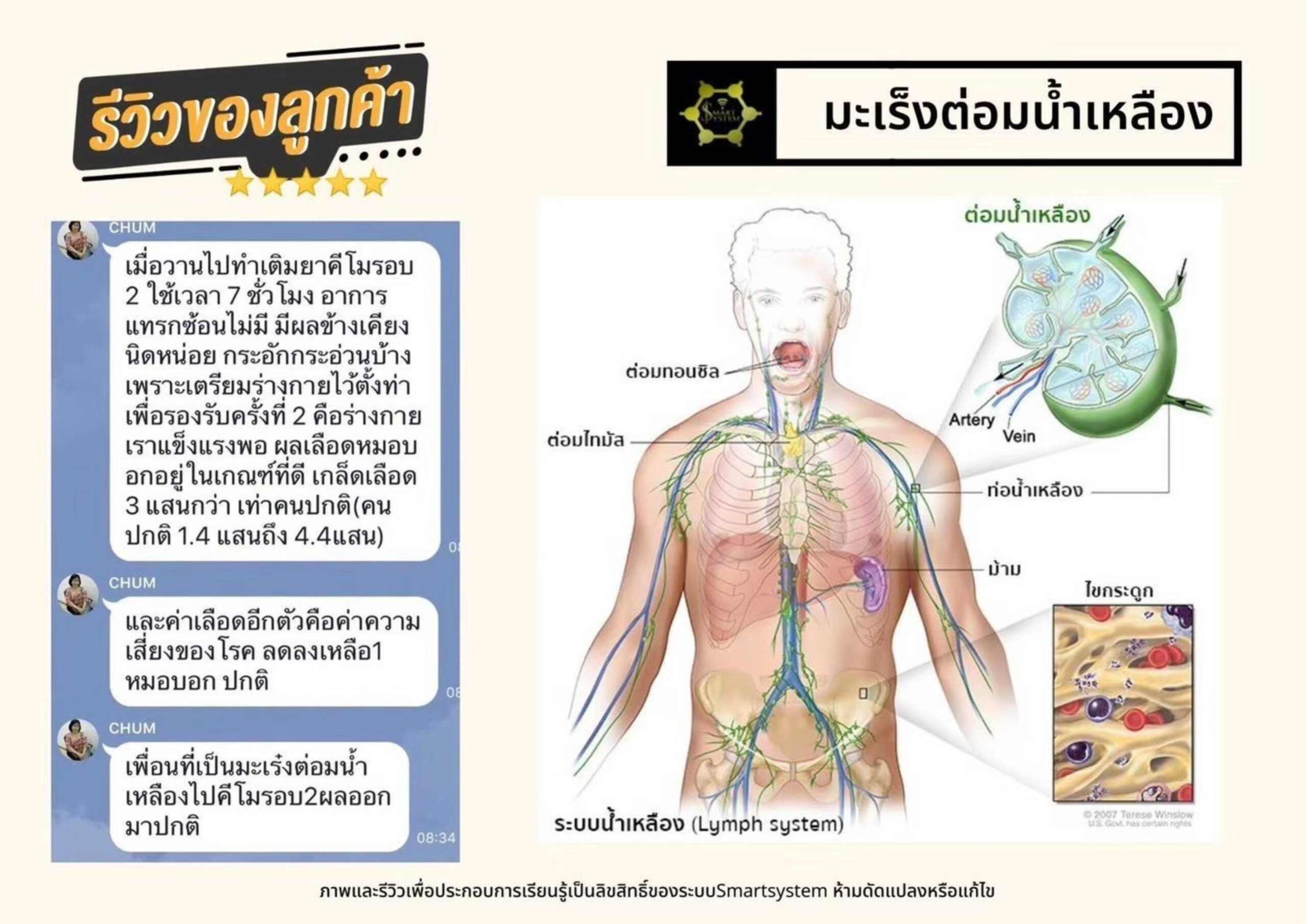มะเร็งต่อมน้ำเหลือง