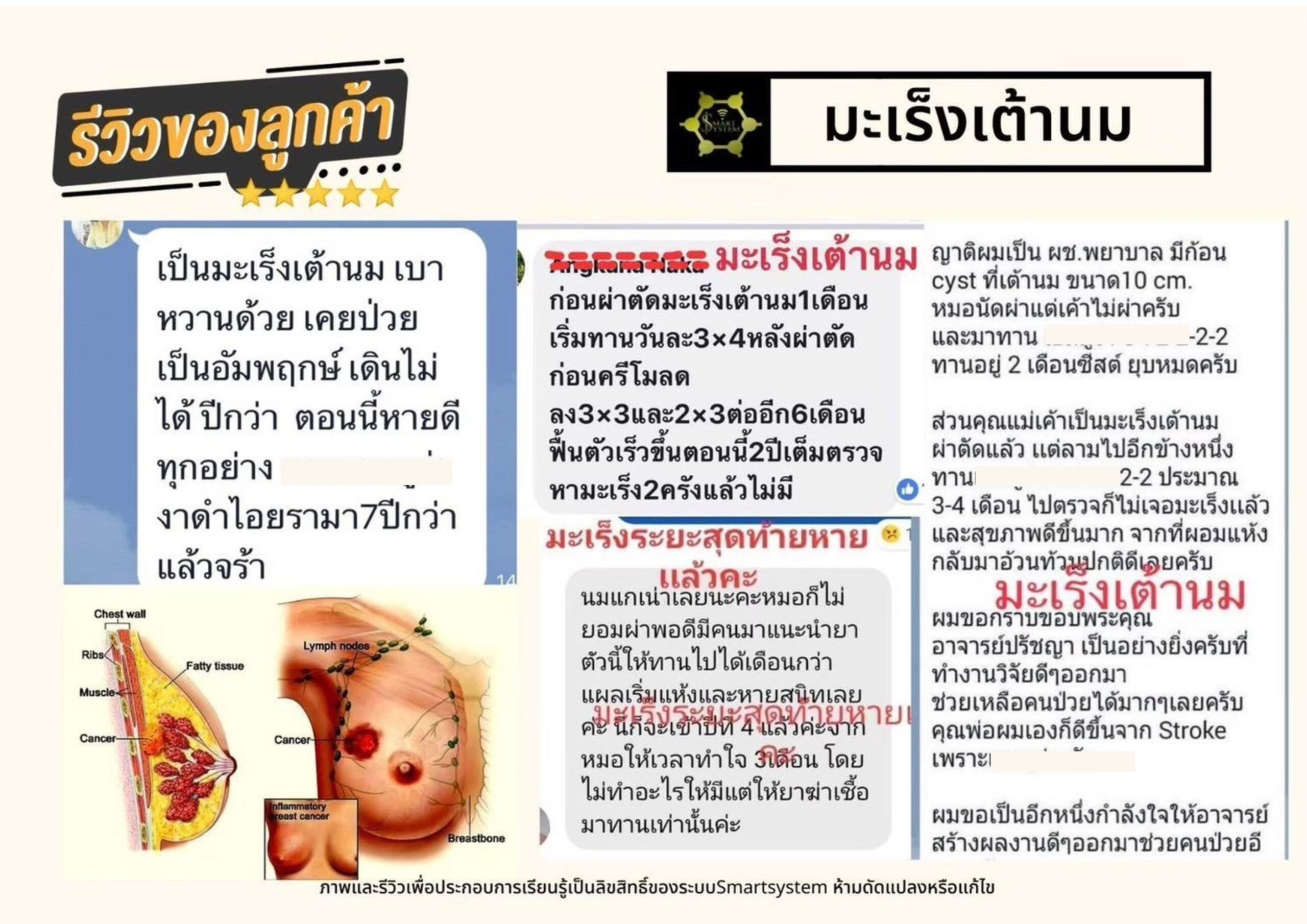 มะเร็งเต้านม